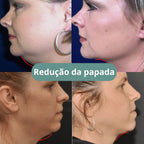 V-Mask – Máscara de Contorno Facial e Redutor de Papada
